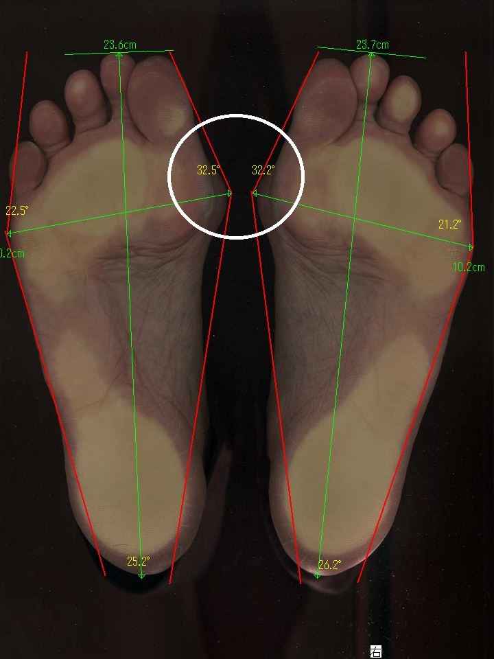 外反母趾で、足の親指が左右とも32度を越え中症