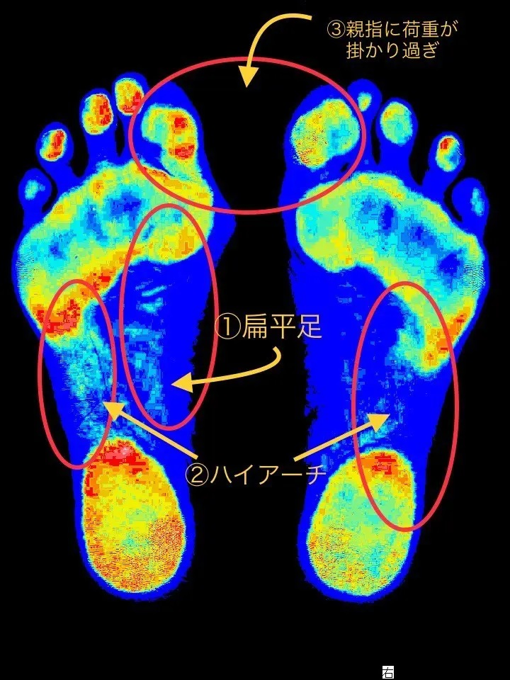 強剛母趾と外反母趾の足の分析結果