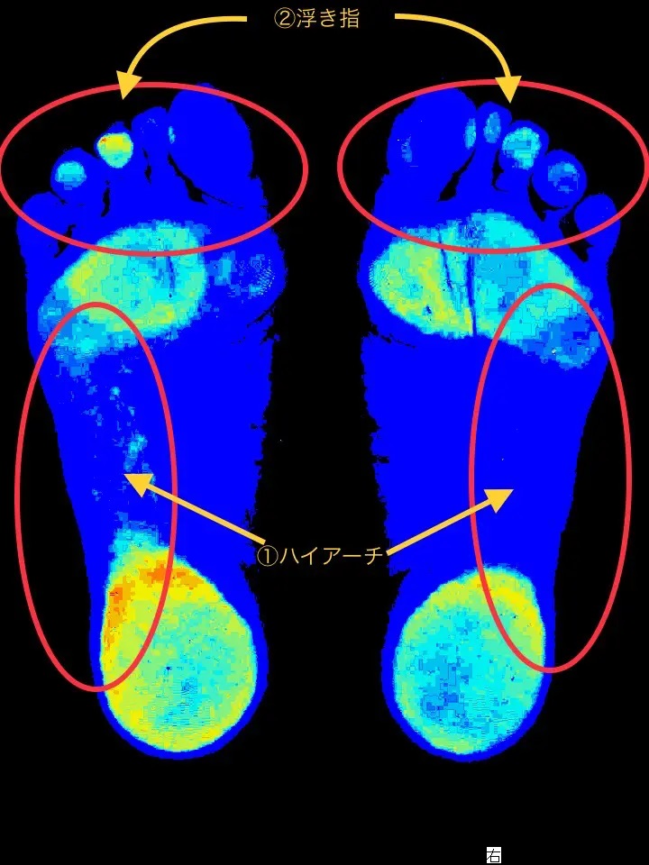 足圧の偏りが外反母趾の原因