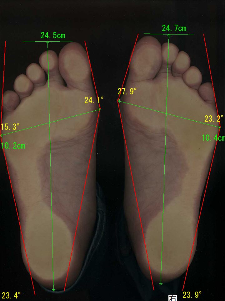 外反母趾は中程度ですが、中足骨骨頭痛症で痛みがある足