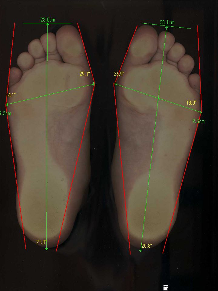 個別相談時の外反母趾、内反小趾の角度計測