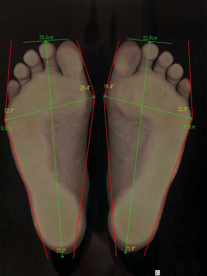 外反母趾の原因を足のサイズ計測で探ります。河内長野の看護師の方の事例