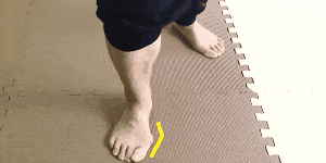外反母趾は、足の使い方で発症する症状の証拠画像