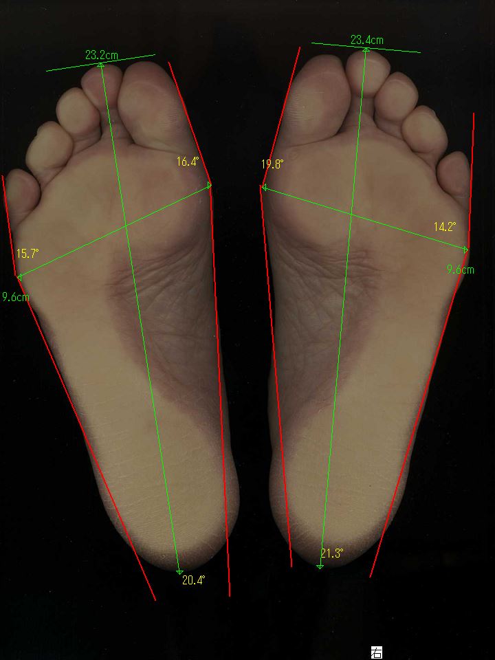 「外反母趾の原因はハイヒール」は間違い。赤く腫れ痛みを感じる外反母趾を4.5ヶ月で改善した太子町の60代女性、靴のウィズサイズが2ランクダウン。好きな靴がはけるように
