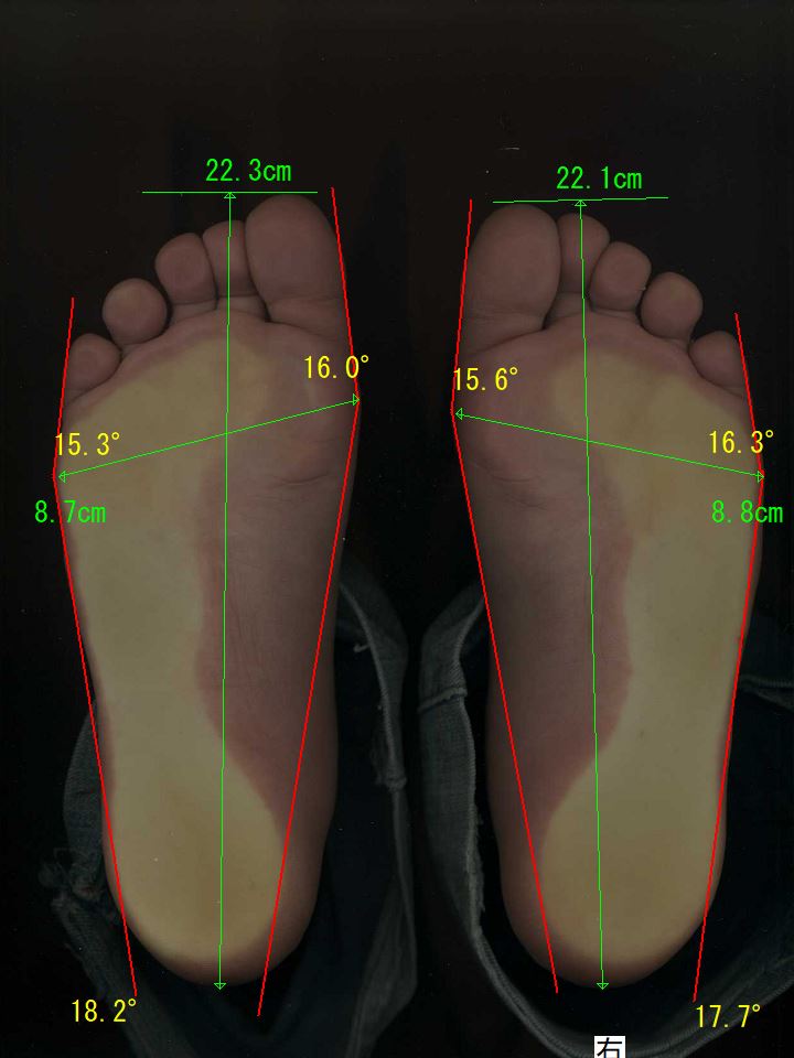 ゆるかかと歩きを始めて2ヶ月後の足。左足が、28.5度 → 16.0度（-12.5度）、右足が、26.3度 → 15.6度（-10.7度）と大幅改善