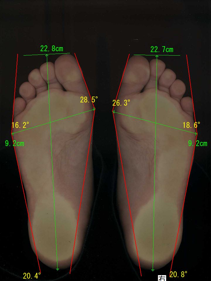 「浮指」「偏平足」「かかとに体重がのっていない」が原因で左足は、28.5度、右足は、26.3度の中程度の外反母趾の中学生の足