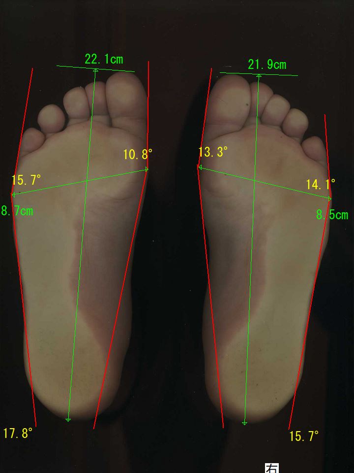 ゆるかかと歩きで、外反母趾の足が大幅に改善。左足は、28.5度から10.8度へ。右足は、26.3度から13.3度に。