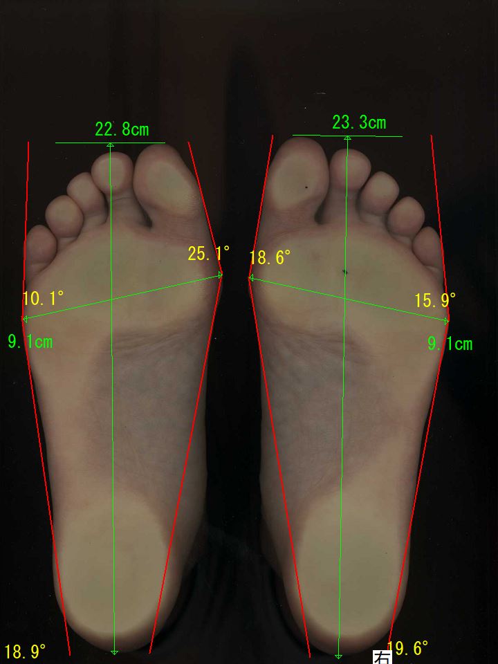 左は中程度、右は中程度に移行しつつある軽度の外反母趾の状態