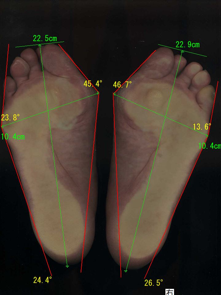 足の親指の角度は、左足は、45.4度、右足は、46.7度、左も右も重度の外反母趾でした。靴のウィズサイズは、両足とも計測不能なほど広がっていました。かなりひどい状況です。