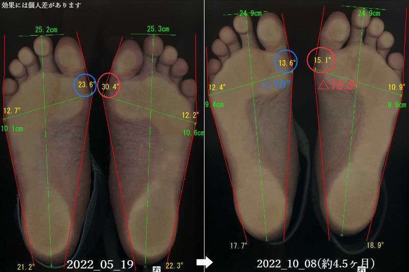 外反母趾が4.5ヶ月で治った足。治療は大阪の名医で。