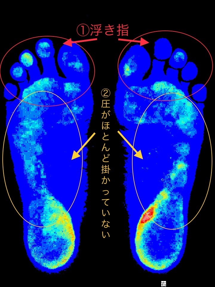 この方の外反母趾の原因は、浮指と圧が殆どかかってない足の状態