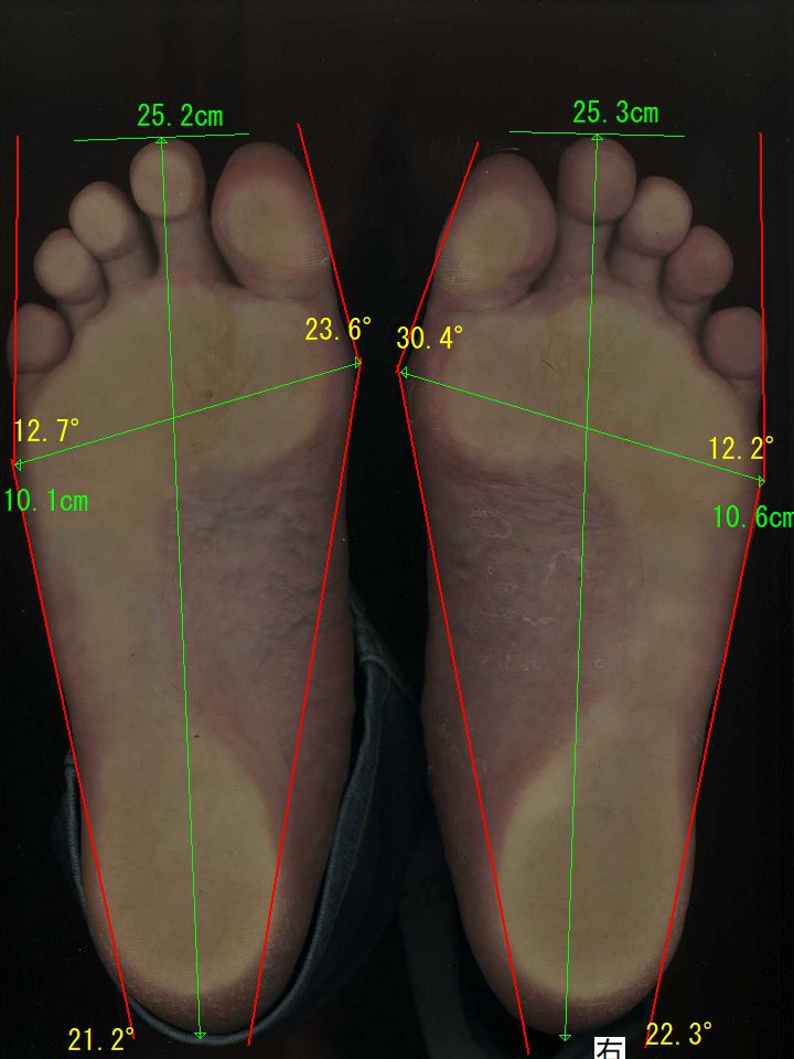 神戸市の50代男性、足の親指の角度は、左足は、23.6度、右足は、30.4度と、中程度の外反母趾の状態。靴のウィズサイズは、左足は、2E、右足は、4Eでした。