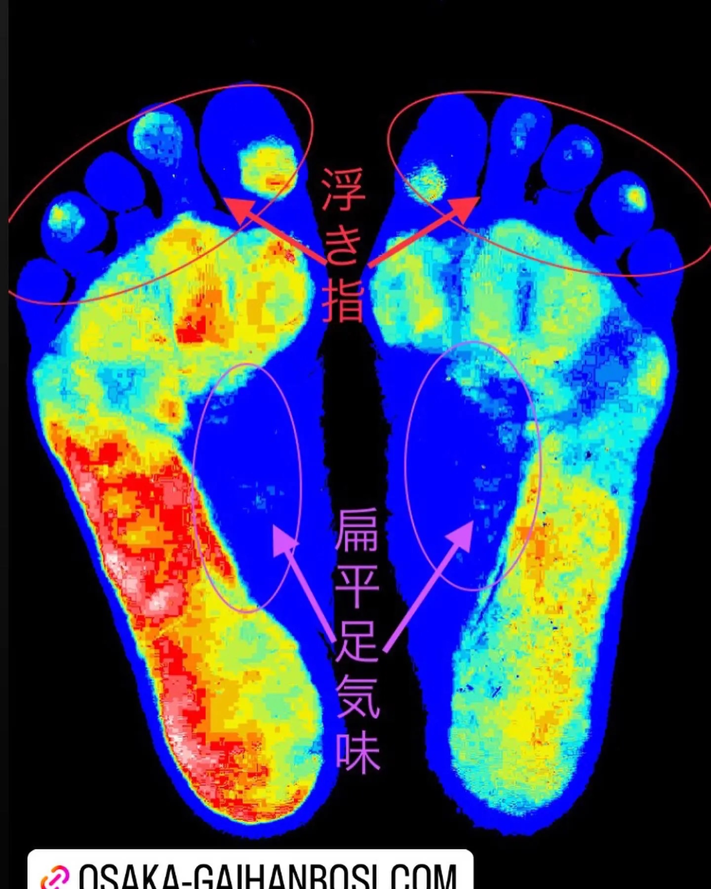 外反母趾の原因が一目でわかる足圧分析