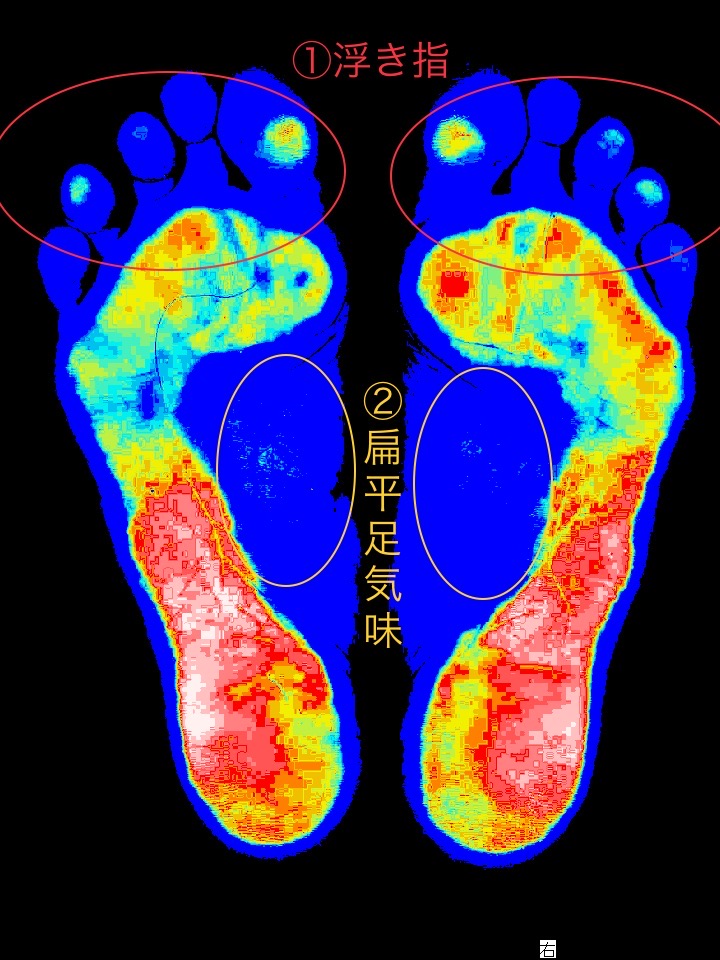 和泉市の外反母趾の女性の足、原因は過剰回内からくる浮指と偏平足でした。