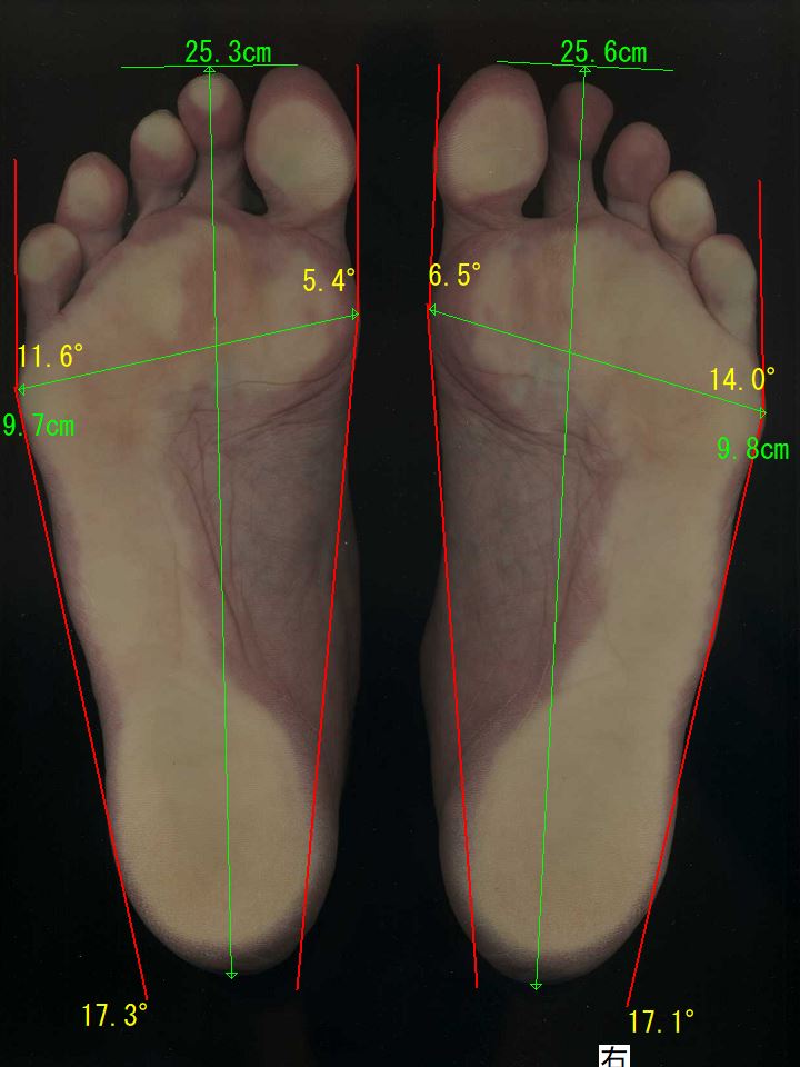 和泉市の形成外科では治らず、外反母趾の治療に来られ、外反母趾が治った女性の足